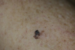 melanoma b 20150309